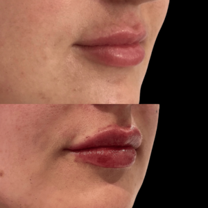 Category: Hyaluron dissolving